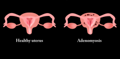 Bệnh lạc nội mạc tử cung là gì